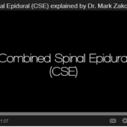 Combined Spinal Epidural (CSE)